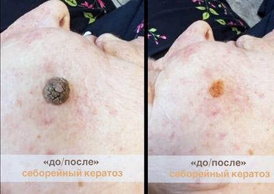 Удаление доброкачественных новообразований 